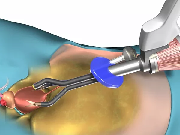 Tek port robotik prostat ameliyatı nedir?